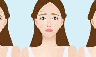 آثار حب الشباب