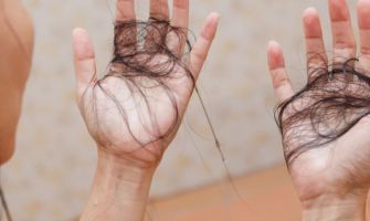 تساقط الشعر المزمن