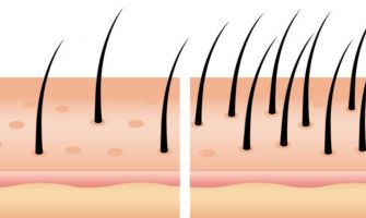 إنبات الشعر