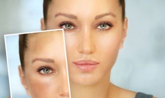 بقع الوجه الدّاكنة